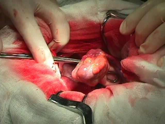 Fig.1 Tumor del ovario en al acto quirurgico - <div style=